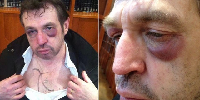 The 59-year-old man, identified only as "David," said he was leaving a kosher restaurant in Paris when three men beat him savagely. (The Algemeiner)