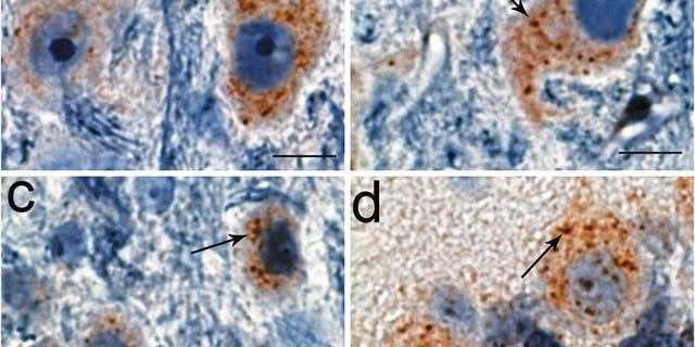 A microscopic look at the protein encoded by the TMEM230 gene.