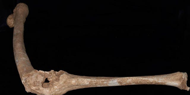 The left leg of an adult male skeleton found in Tomb I at Vergina. The thigh bone (femur) and one of the bones of the lower leg (the tibia) are fused, and hole at the knee suggests a devastating penetrating injury.