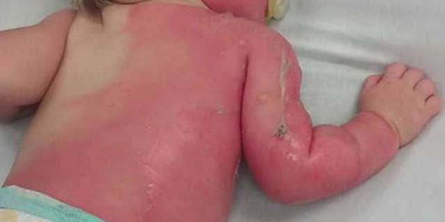 A baby was left with second-degree burns after being sprayed by a hose.