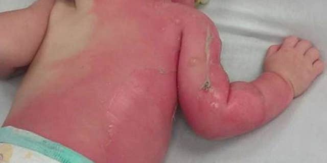 A baby was left with second-degree burns after being sprayed by a hose.