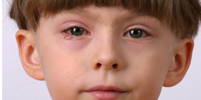 ill allergic eyes - conjunctivitis