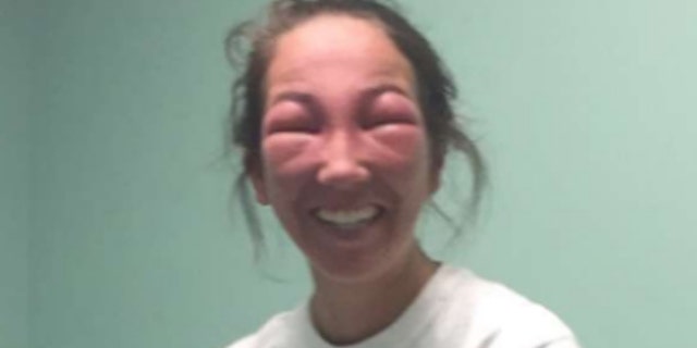 Emily Petrozza got poison ivy in her eye.