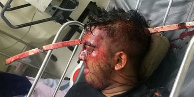 An Indian youth was discharged from hospital a month after doctors successfully removed a 3.5-feet-long iron rod that had pierced his skull in a freak car accident. See SWNS story SWROD; Mohammad Taraque, 24, was released from the Apollo Gleneagles Hospital in Kolkata in West Bengal on Tuesday, a month after a complex brain surgery. Taraque had suffered a massive car accident on April 28 in which a 3.5 ft long iron rod of the roadside divider impaled his forehead leaving him profusely bleeding. He was brought to the hospital with very little life expectancy.