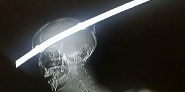 Keeping the bleeding under control during the rod’s removal was the most difficult part, but things went as well as could be expected during the two-and-a-half-hour procedure.