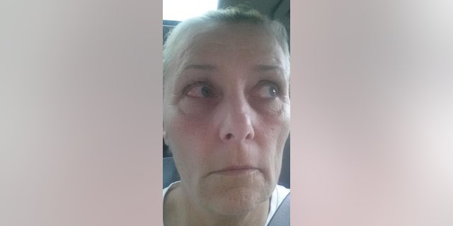 Allan claims one of her eyes swelled to the size of a "golf ball" following the incident.