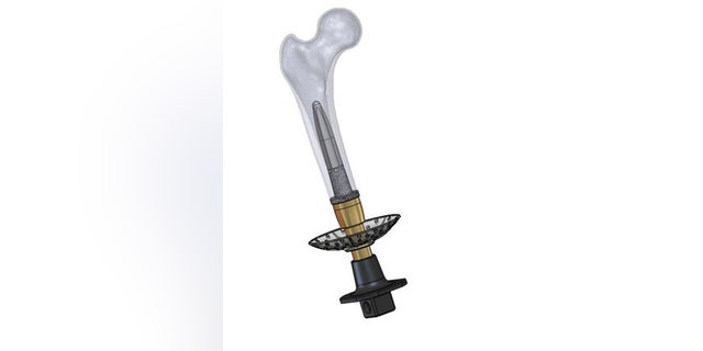 Percutaneous Osseointegrated Prosthesis (POP) assembly with bone.