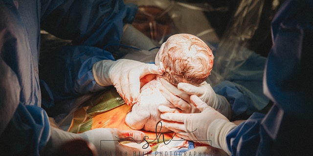 Dial said, “It was an incredible feeling to reach down, feel her head, then slowly feel the rest of her coming, but a little strange not being able to feel the rest of my abdomen.”