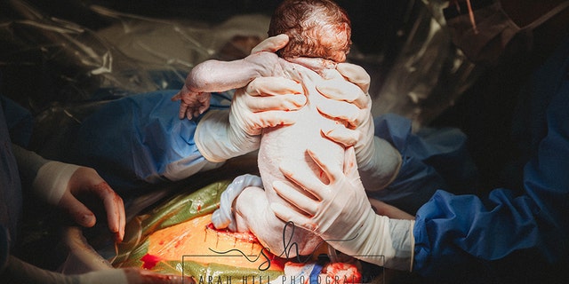 Once doctors made the initial cut, Dial reached down and pulled her daughter Emma out.