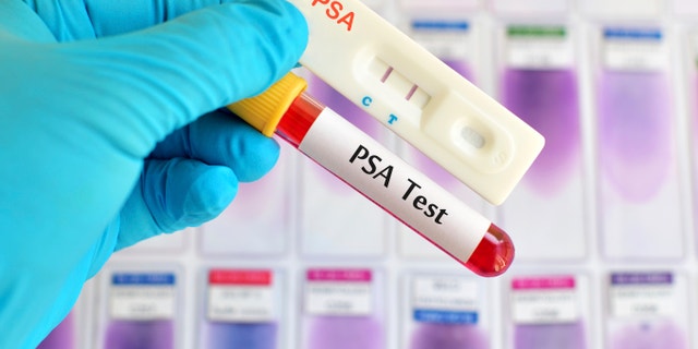 PSA testing (prostate cancer diagnosis) by using test cassette, the result showed positive (double red line)