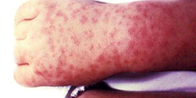 People who are infected with RMSF will likely develop a rash.