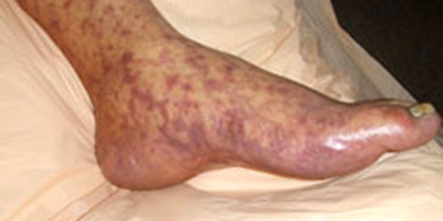 What is Rocky Mountain spotted fever? Signs, symptoms and treatment for