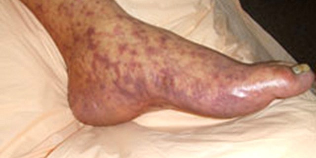 The disease can lead to the loss of limbs.