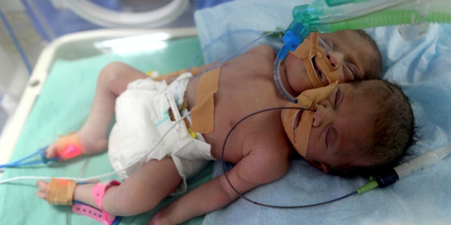 GAZA-CONJOINEDTWINS/