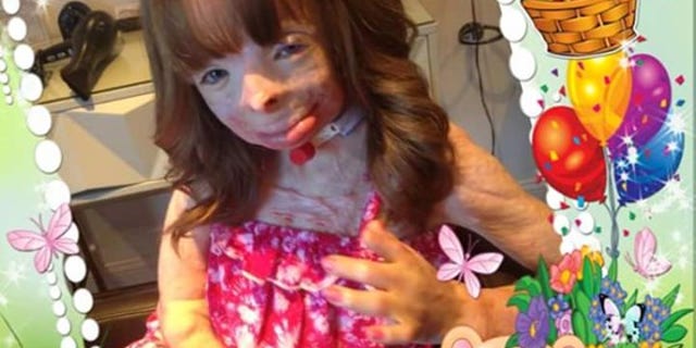 Safyre Terry suffered burns on more than 75 percent of her body in a fire that killed her siblings and father.