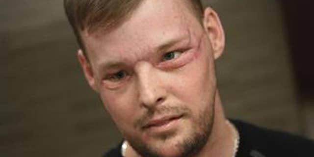 Face transplant recipient Andy Sandness attends a speech therapy appointment at the Mayo Clinic in Rochester, Minn., on Jan. 24, 2017. (AP photo)