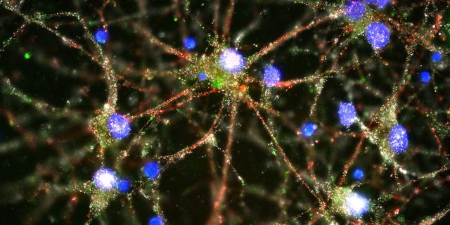 Jan. 27, 2016: Scientists pursuing the biological roots of schizophrenia have zeroed in on a potential factor -- a normal brain process that gets kicked into overdrive.