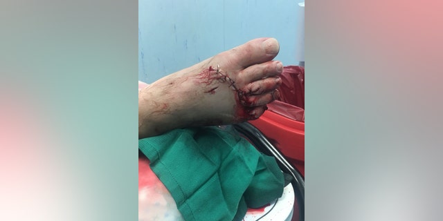 Newman received 12 stitches in his right foot after the attack.