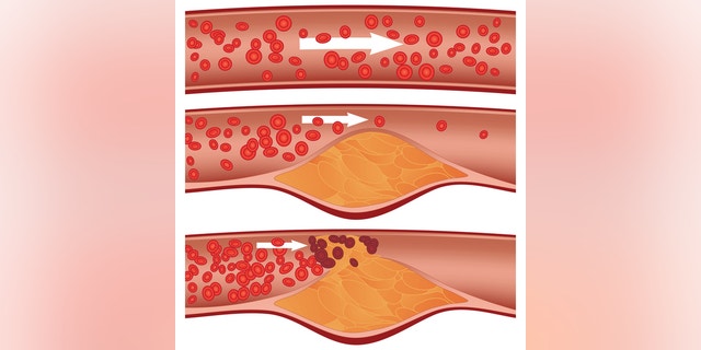 Cholesterol plaque in artery (atherosclerosis): Top artery is healthy. Middle & bottom arteries show plaque formation, rupturing, clotting & blood flow occlusion.