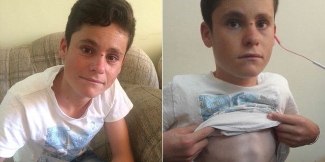 Ahmed bears the scars of beatings at the hands of his ISIS captors, but did not allow them to break his will. (Special to FoxNews.com)