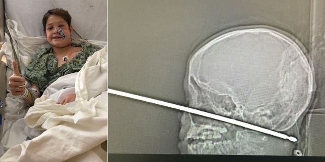 Xavier Cunningham at the hospital after he had the meat skewer removed from his face. The X-ray shows the skewer that went into the boy's face.