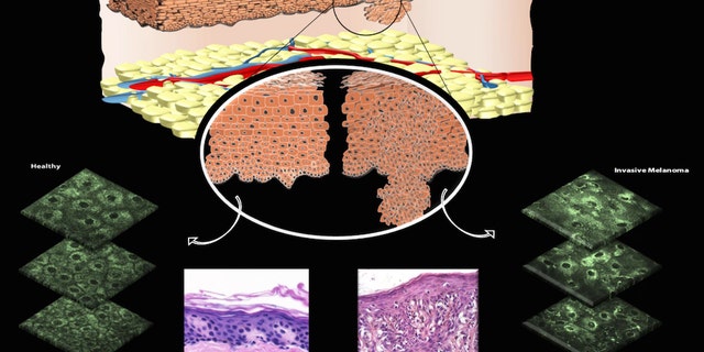 The top illustration shows both healthy (left) and unhealthy (right) cells, along with images taken of skin that's healthy (lower left) and skin with an invasive melanoma lesion (lower right).