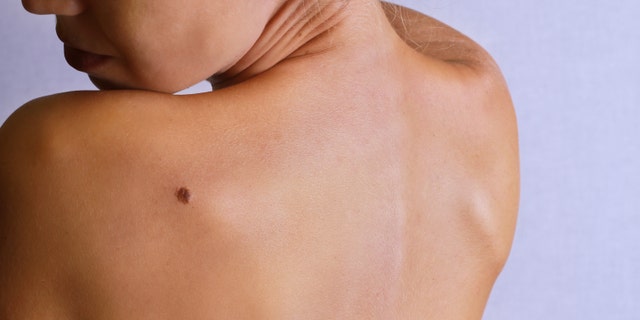 Young woman lookimg at birthmark on her back, skin. Checking benign moles