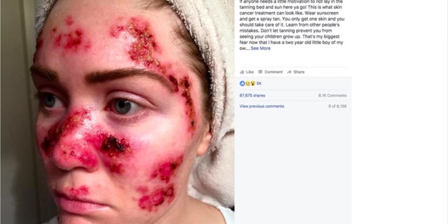 Tawny Willoughby's selfie triggered near record-setting levels of online searches about skin cancer and its prevention, according to the study.