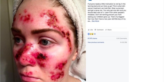 Tawny Willoughby's selfie triggered near record-setting levels of online searches about skin cancer and its prevention, according to the study.