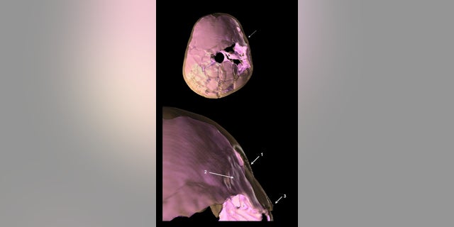 A Paleolithic child that died 100,000 years ago may have suffered from brain damage after an injury. Researchers used a 3D reconstruction (shown here) to reveal the compound fracture and surface changes inside the skull.