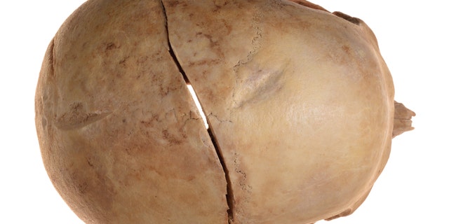 The cracks in the skull. (Credit: Clara Amit, Israel Antiquities Authority)