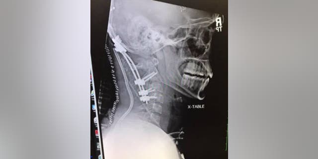 The X-ray of Meister's neck.
