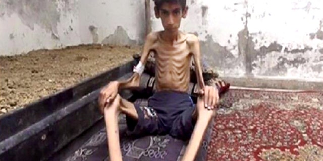 This undated photo posted on the Local Revolutionary Council in Madaya, which has been verified and is consistent with other AP reporting, shows a starving boy in Madaya, Syria. (Local Revolutionary Council in Madaya via AP)