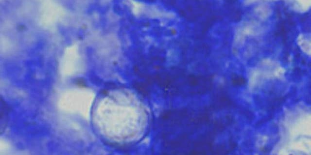 Oocysts of Cyclospora cayetanensis stained with modified acid-fast stain.