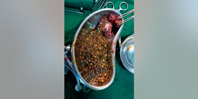 The team of doctors who performed the 30-minute surgery under the supervision of laparoscopic surgeon Dr. BC Shah were left baffled after they counted the number of stones removed.