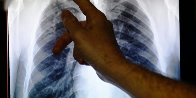 Jan 27, 2014 -Clinical Dr Al Story points to x-ray showing lungs infected with TB (tuberculosis) in London. (REUTERS)