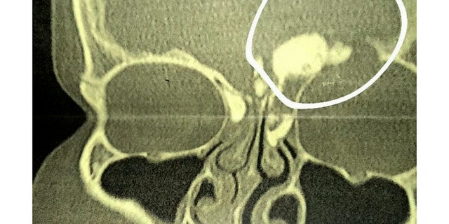 CT scans and X-rays revealed a mass pressing on Megan Barker's left eye socket. Doctors decided the tumor was too big and proceeded to perform a craniotomy.