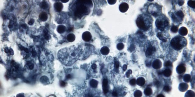 Naegleria fowleri in human brain tissue.