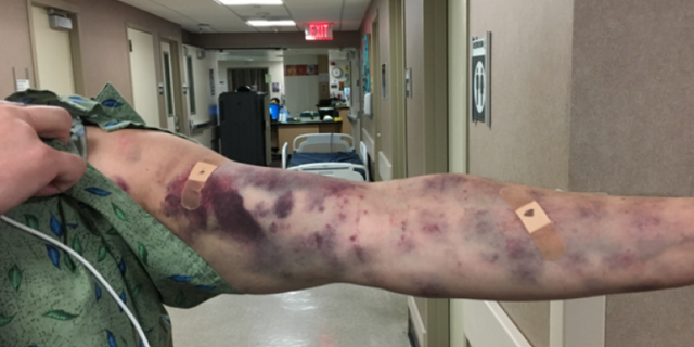 Thomas Jay said he was bit by something that looked like a "cross between a scorpion and a spider."