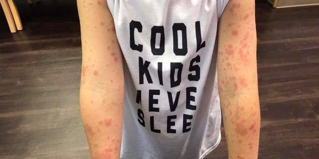 The young boy also had other symptoms that included fatigue, diarrhea and a fever.