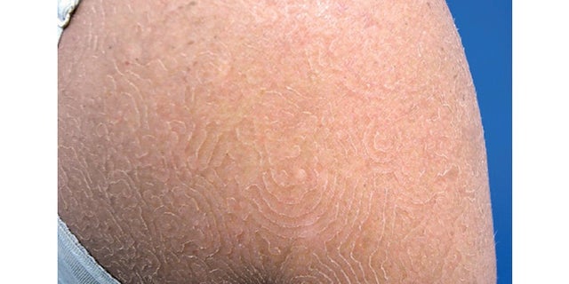 This image shows a young woman's rash, caused by the fungus Trichophyton concentricum.