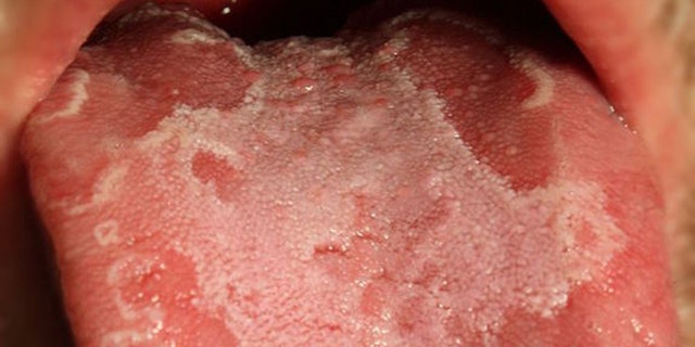 The unusual condition known as "geographic tongue" causes red and white patches that give the appearance of continents on a map.