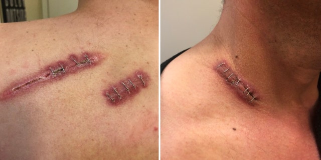 Tony Garces shows his injuries from being shot twice by police. Garces disarmed a gunman at a Texas church before police arrived on scene and shot him.