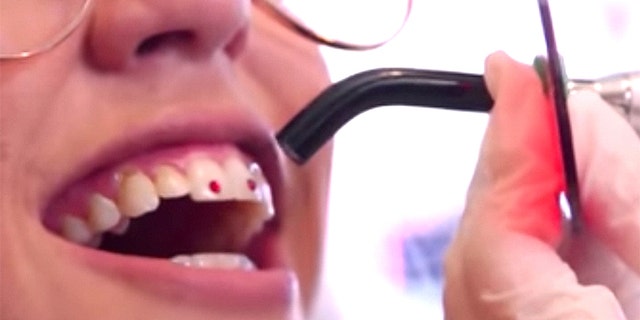 Gluing small gems and jewelry on your teeth is becoming the latest trend.