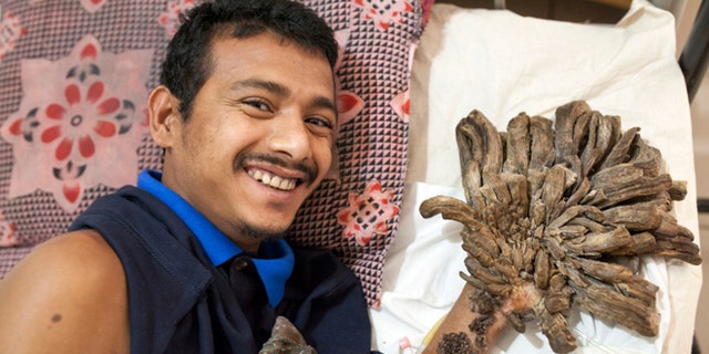 Abul Bjandar had growths on his hands and legs weighing up to 11 pounds.