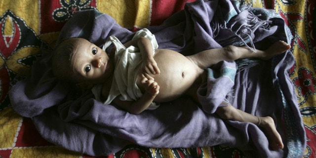 A five-month-old child with tuberculosis rests inside the tuberculosis ward of a hospital in India. (REUTERS/Rupak De Chowdhuri)