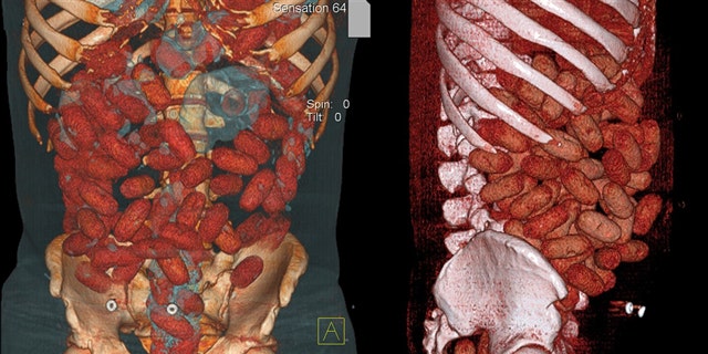 This handout medical image released by the Brazilian Federal Police shows cocaine-stuffed bags inside the gastrointestinal tract of a 20-year-old Irish national arrested by police at Congonhas airport in Sao Paulo, Brazil, on September 12.