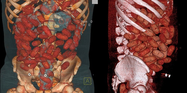 This handout medical image released by the Brazilian Federal Police shows cocaine-stuffed bags inside the gastrointestinal tract of a 20-year-old Irish national arrested by police at Congonhas airport in Sao Paulo, Brazil, on September 12.