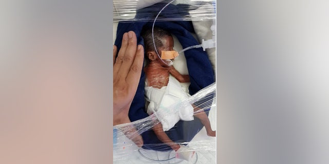 Micro Preemie Twin Babies Born At 24 Weeks Weighing 1 3 Pounds Fox News