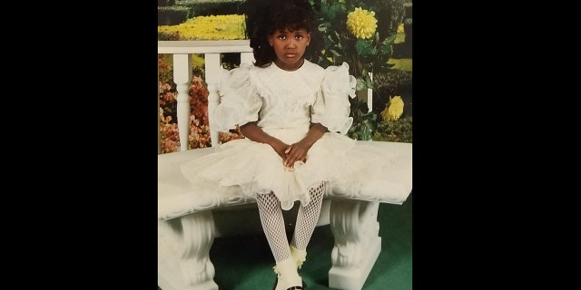 The model was cruelly mocked as a young girl by classmates who said it looked like her leg was "dying" and covered up under long pants and skirts for years in shame.